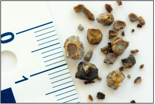 Avoid the Pain of Kidney Stones