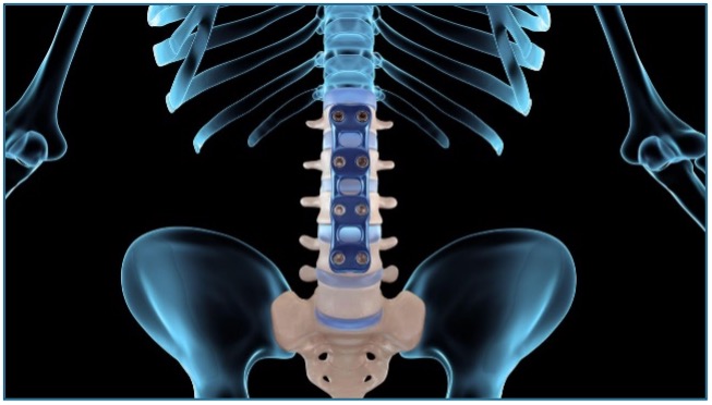 Hospitals Called Out for Unnecessary Back Surgeries on Seniors