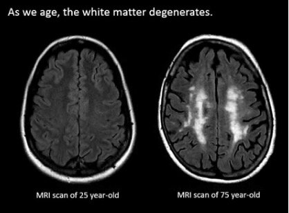 What Happens to the Brain as We Age?